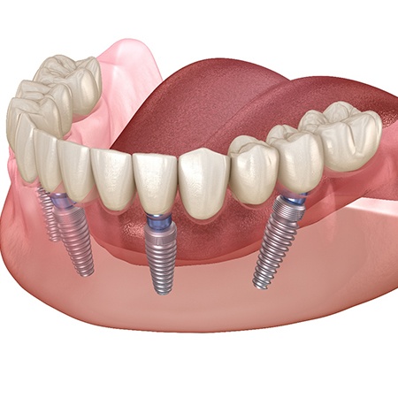 A diagram of All-on-4 dental implants in Savannah.