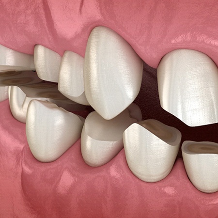 computer model of worn-down teeth