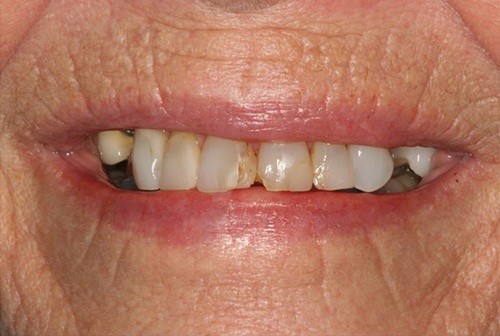 Severely decayed top teeth