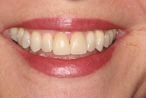 Closed gap between front two teeth