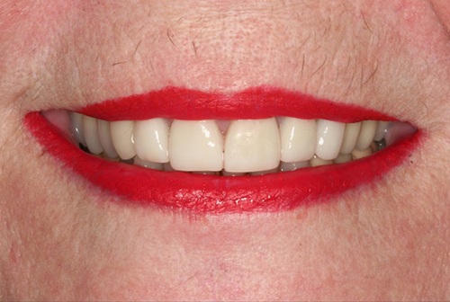 Renewed oral health and dental appearance