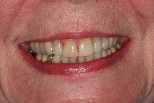 Damaged teeth and gums