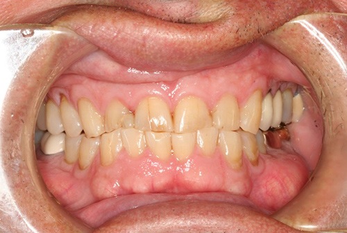Severely damaged teeth with extensive decay