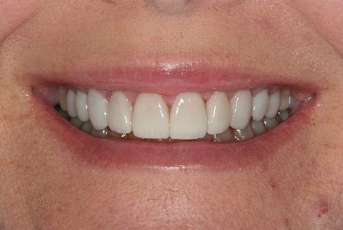 Healthy smile after gum tissue reshaping