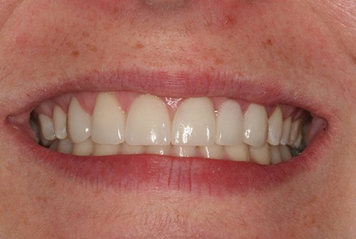 Smile after cosmetic enhancement